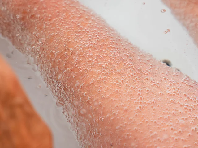 Soin en phlébologie : Les Bains Carbogazeux par Lucas Giraudeau